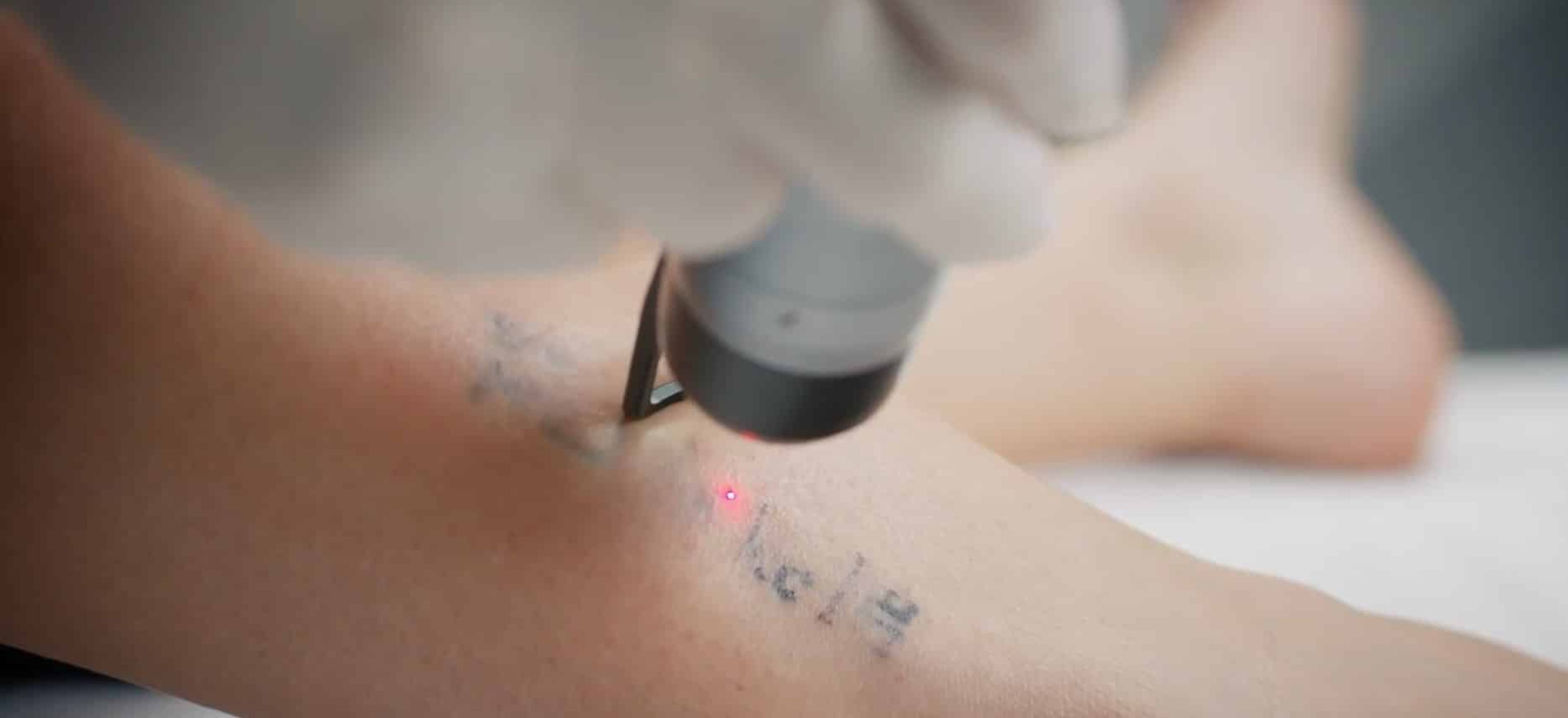 ClearLift Tattoo Removal