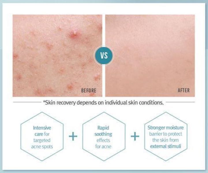 Pyunkang Yul Acne Dressing Mask Pack