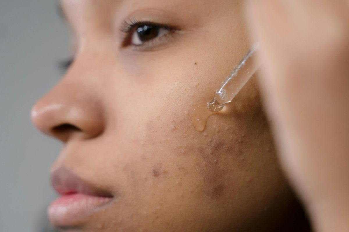 Woman applying serum to the face on her hyperpigmentation