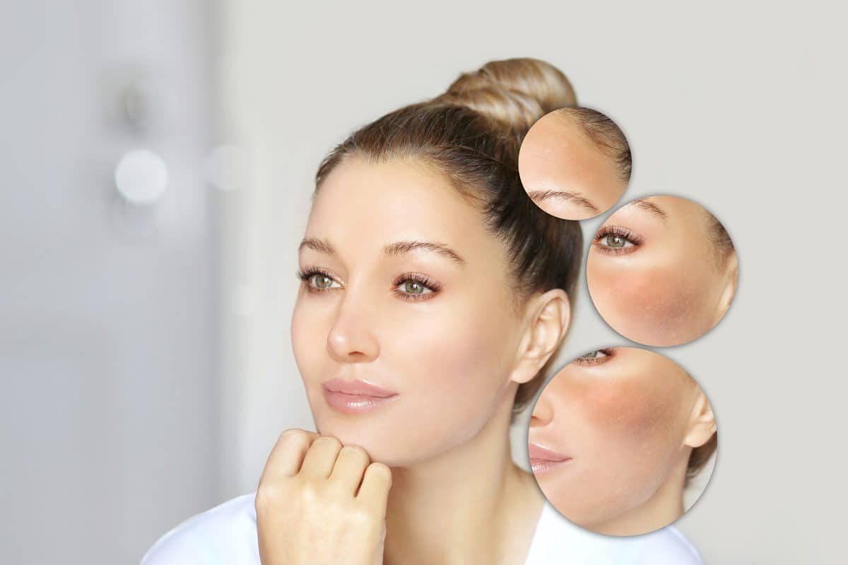 Three circles zoom in on the hyperpigmentation on a woman's face