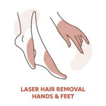 Hand & Feet Laser Hair Removal Treatments
